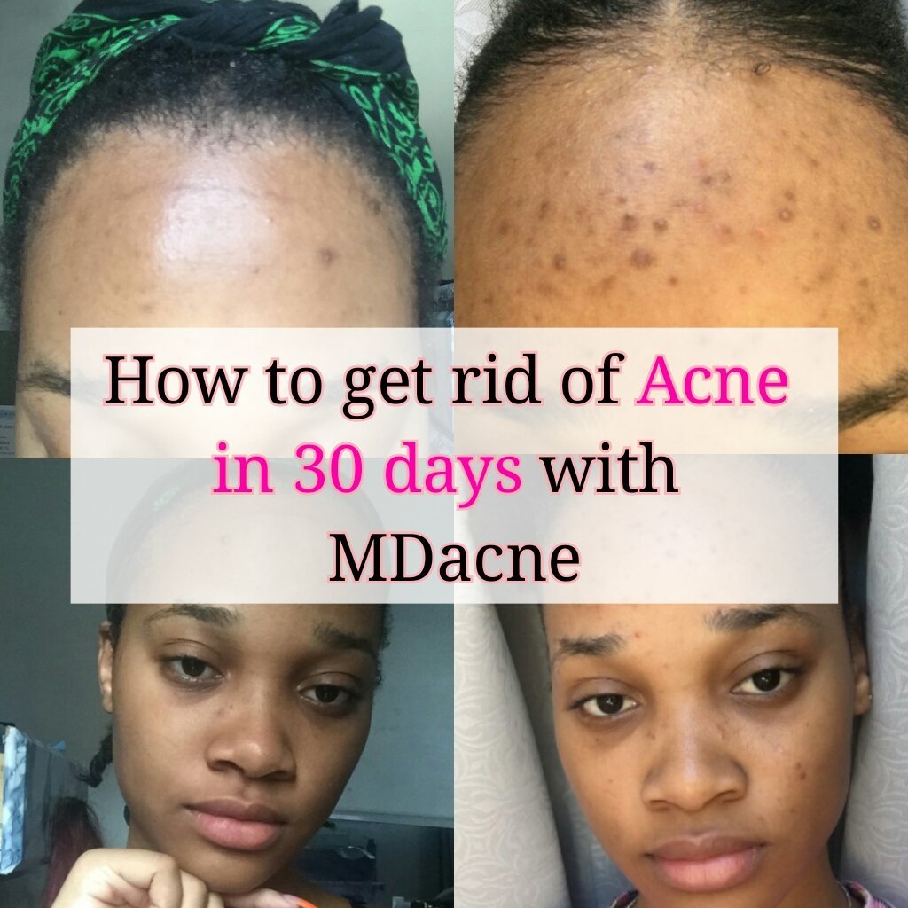 How To Get Rid Of Bad ACNE In 30 Days?!